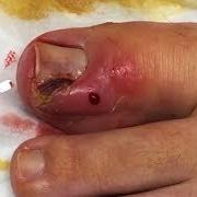 Hangnail